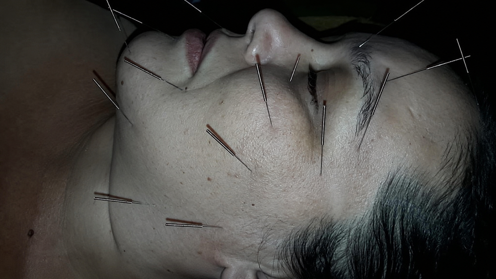 Paciente con acupuntura para recuperación de parálisis facial